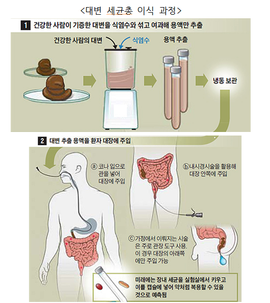 대변 세균총 이식(Fecal Microbiota Transplantation) 이미지