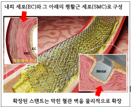 심혈관 질환의 스텐트 시술 부작용, 새로운 레이저 패터닝 기술만으로 해결한다